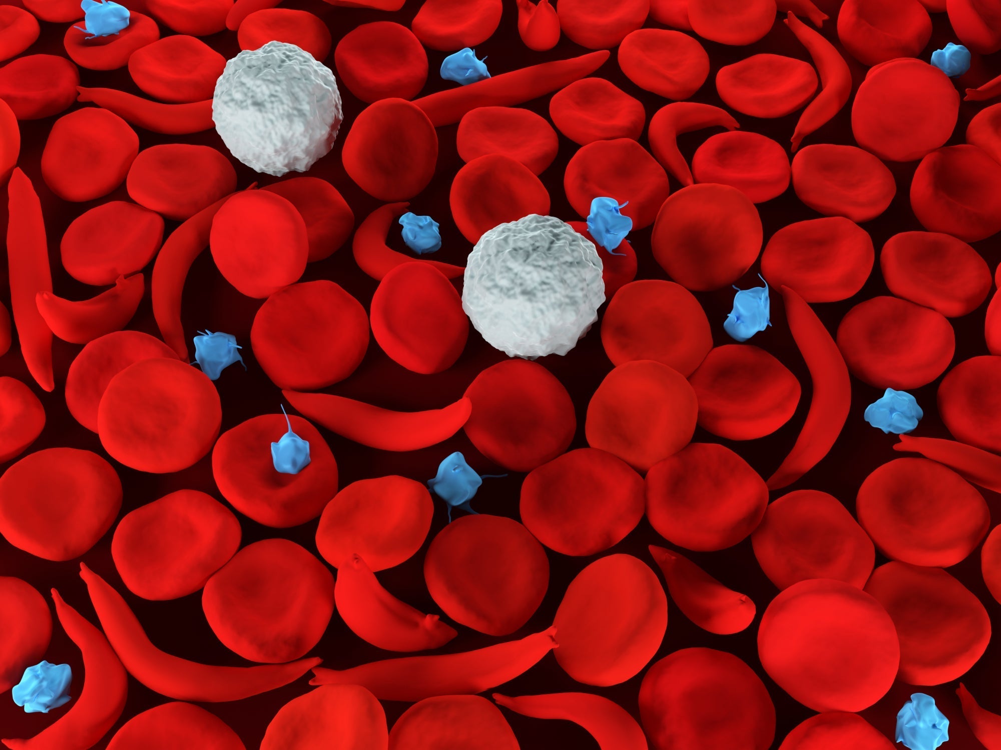 Understanding Sickle Cell Disease: Causes, Symptoms, and Treatment