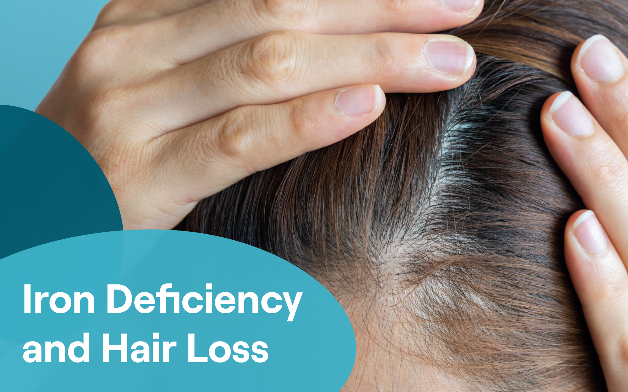 Vitamin D Deficiency and Hair Loss: What's the Connection?