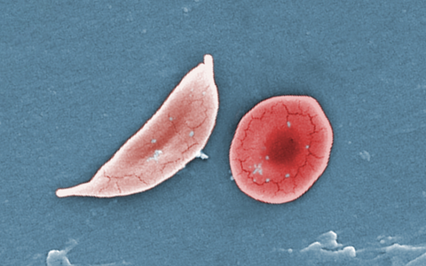 Sickle Cell Anemia